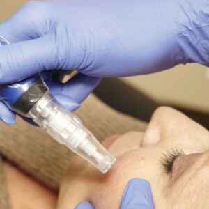 SkinPen Microneedling