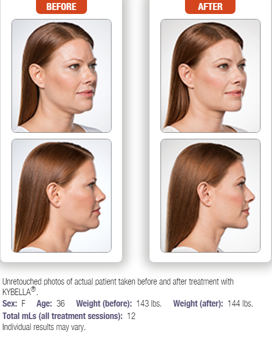 kybella-1