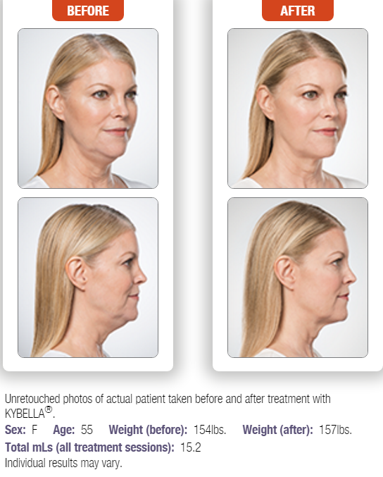 kybella-2