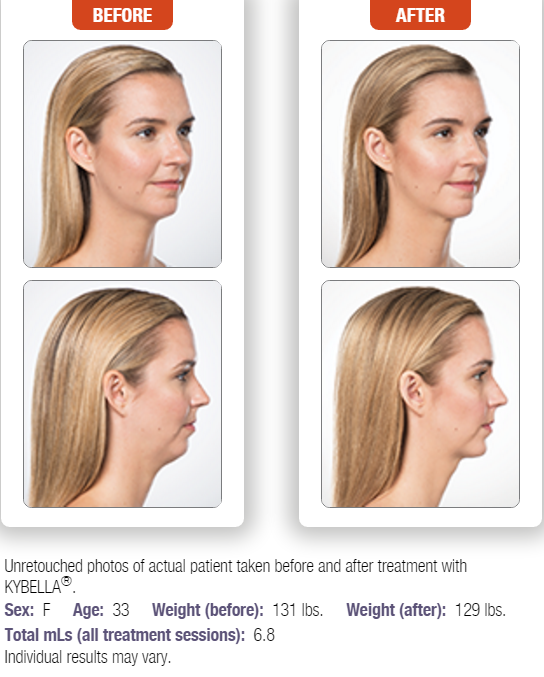 kybella-4