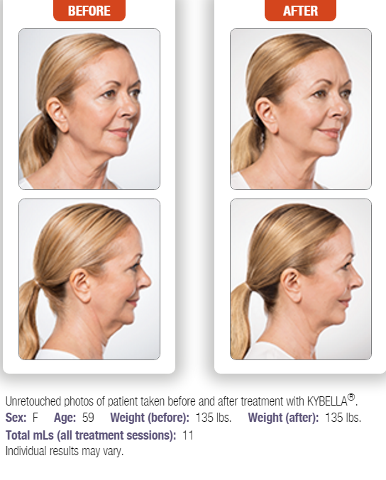 kybella-5