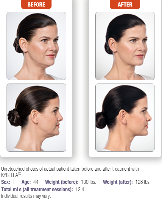 kybella-6