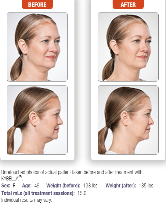 kybella-7