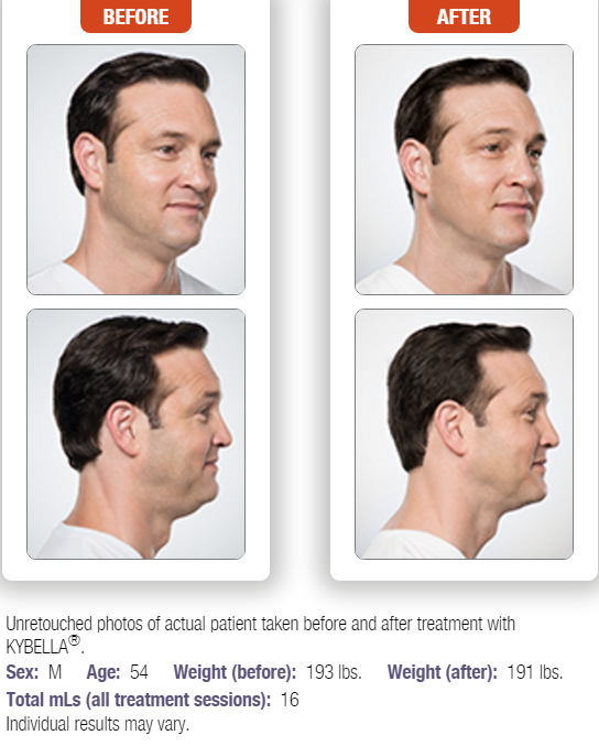 kybella-8