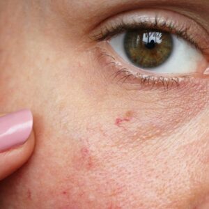 Redness & Vein Eraser