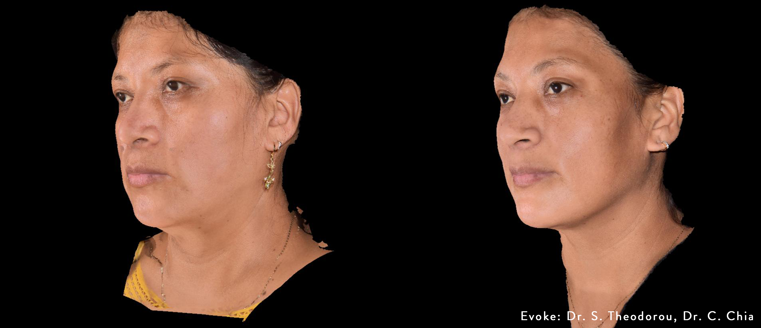 STCC_Evoke_3d_LeftAngleVolumeQuant