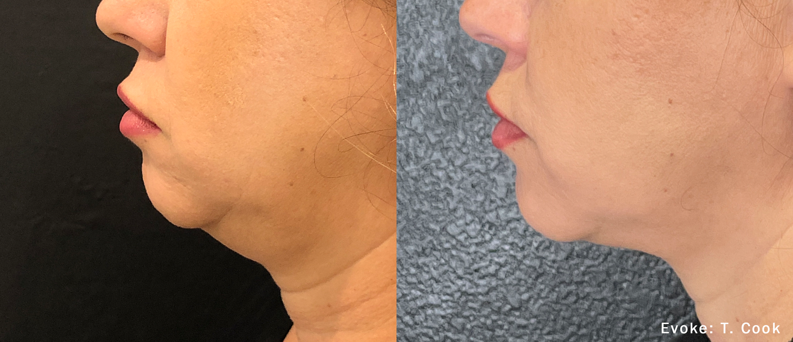 TC_Evoke_1a7weeks_Chin