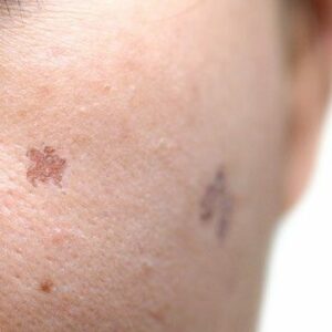Age & Brown Spot Eraser