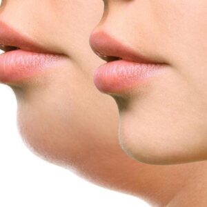 TheraContour: Masseter TMJ Treatment