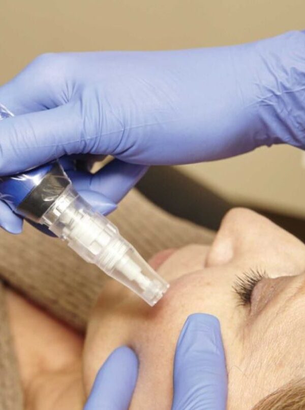 Microneedling Denver