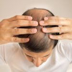 PRP/PRF Hair Restoration Denver